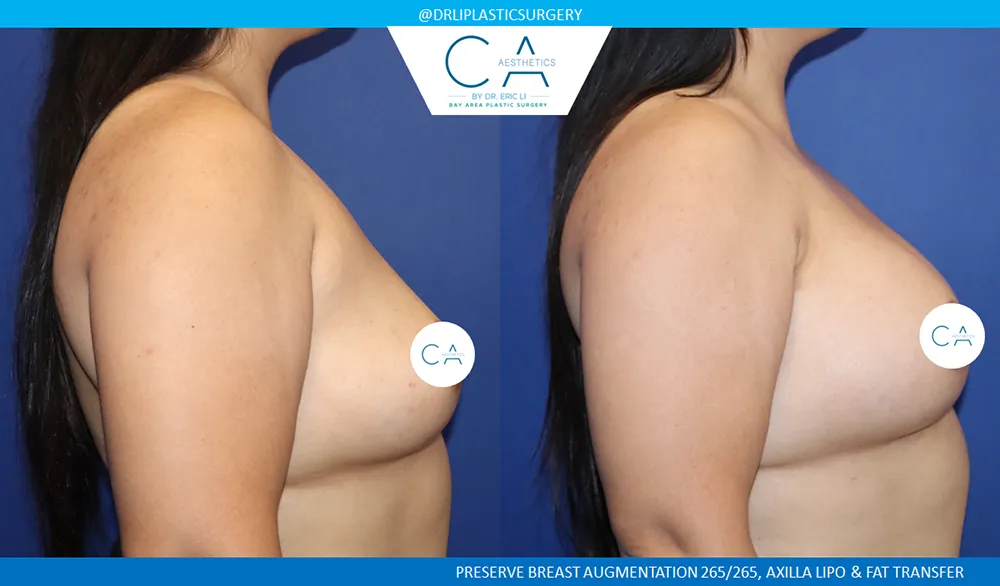 Preserve Breast Augmentation case #9386