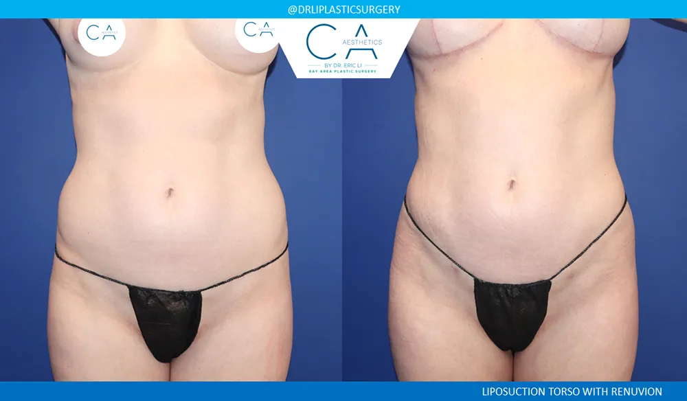 360 Liposuction (Torso) case #9398