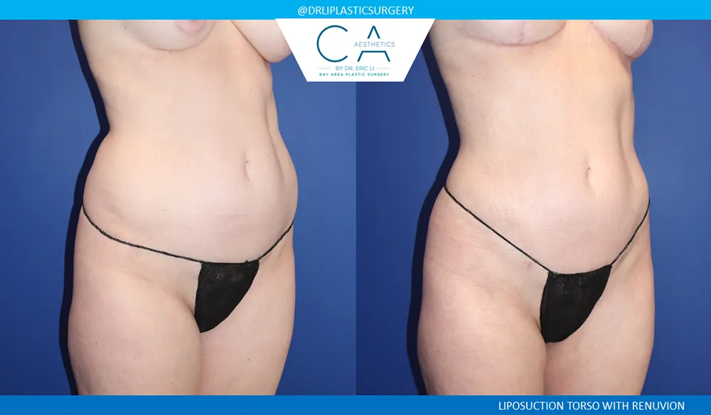 360 Liposuction (Torso) case #9398