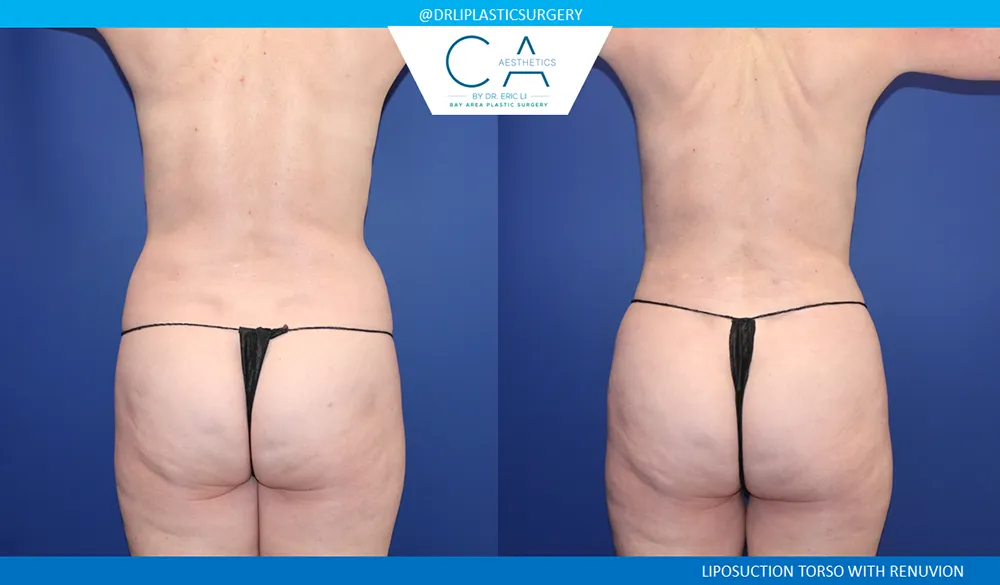 360 Liposuction (Torso) case #9398