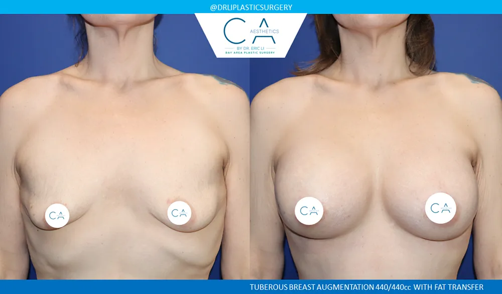 Tuberous Breast Augmentation case #9656