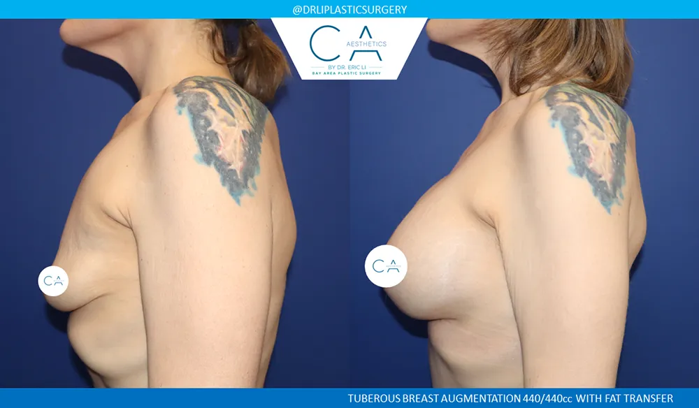 Tuberous Breast Augmentation case #9656