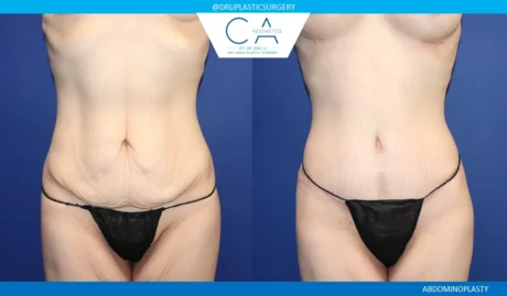 Tummy Tuck case #9476