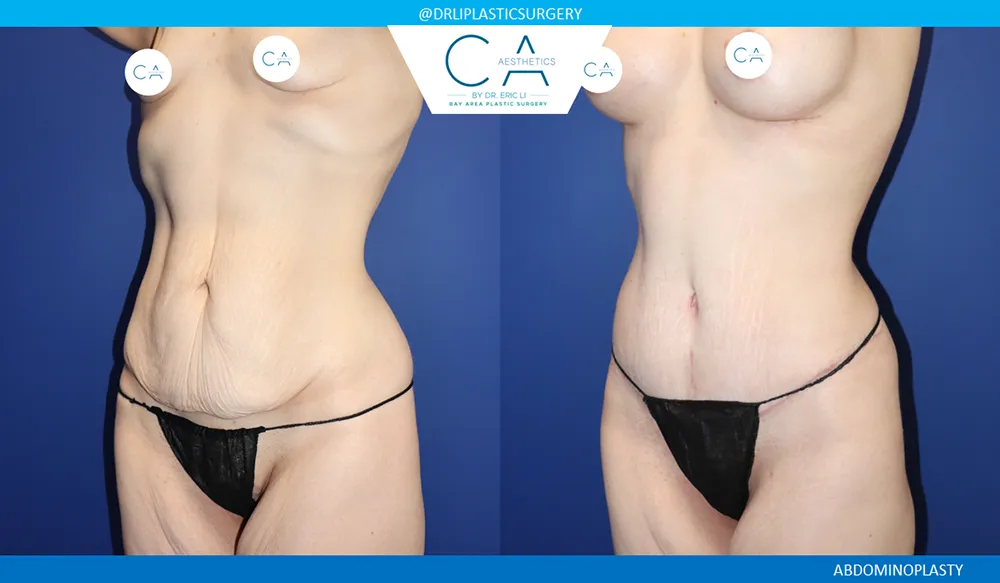 Tummy Tuck case #9476