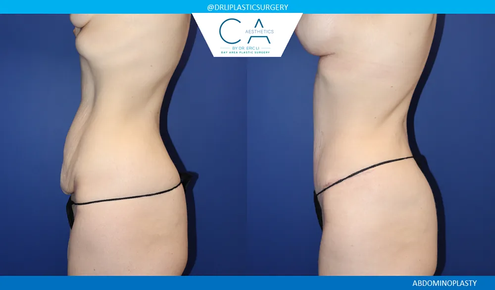 Tummy Tuck case #9476