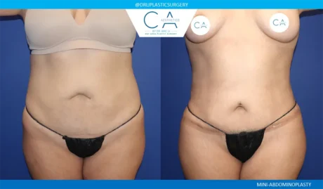 Tummy Tuck case #9471