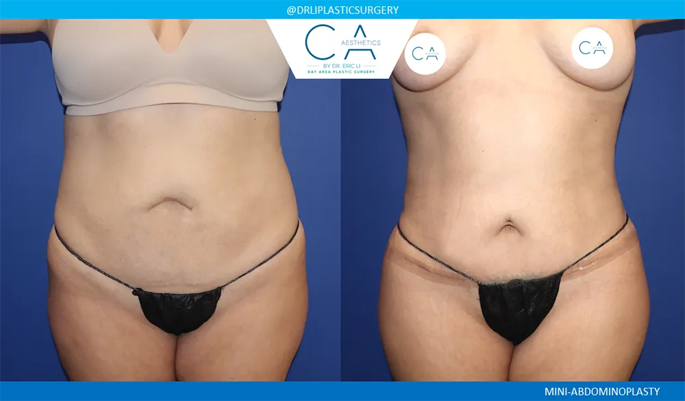 Tummy Tuck case #9471