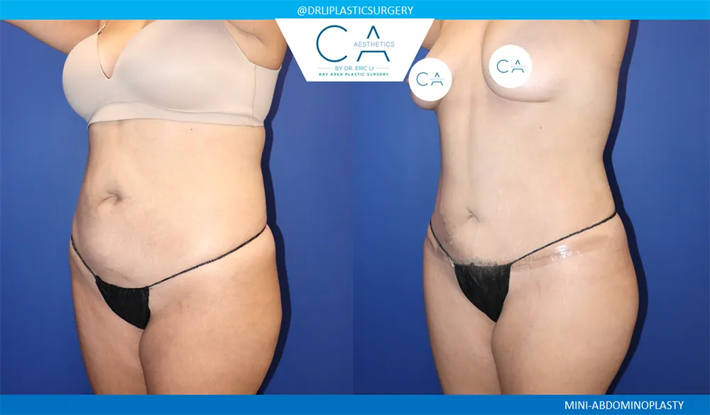 Tummy Tuck case #9471